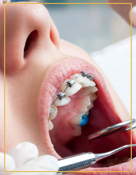 Sabit Ortodontik Tedavi İzmir Denta Point Karşıyaka ve Bostanlı Diş Sağlığı Poliklinklerinde