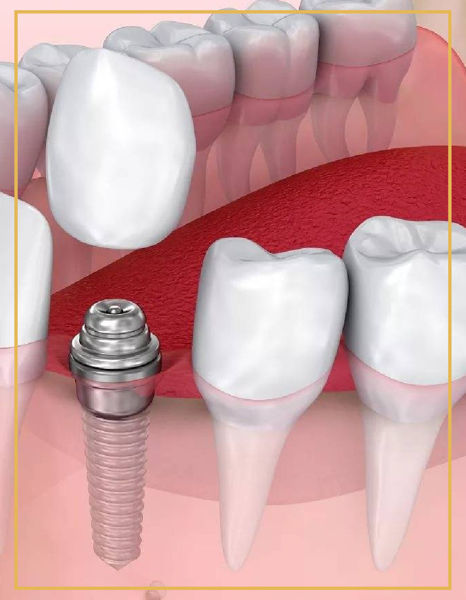 Vidasız İmplant Diş Tedavileri İzmir Denta Point Ağız ve Diş Sağlığı Bostanlı ve Karşıyaka Polikliniklerinde Hizmetinizdedir.