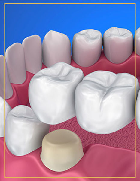 Picture of Dental Bridge Prosthesis