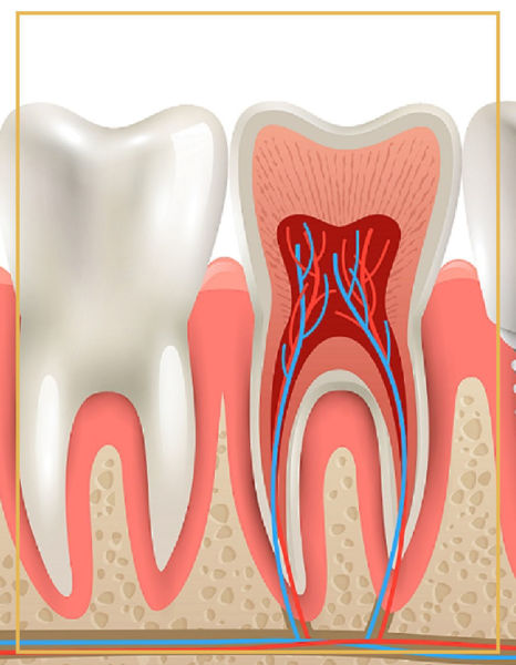 Picture of Dental Root Canal Treatment 