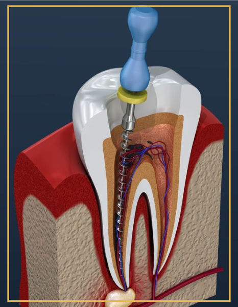 Picture of Apical Resection 