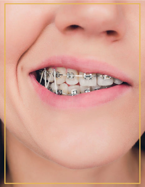 Metal Bralet ve Ortodonti İzmir Karşıyaka ve Bostanlı DentaPoint Poliklinklerinde